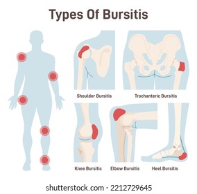 Types of bursitis set. Shoulder, hip, heel, knee and elbow joints inflammation. Inflamed or irritated bursae of synovial fluid. Musculoskeletal system disease. Flat vector illustration