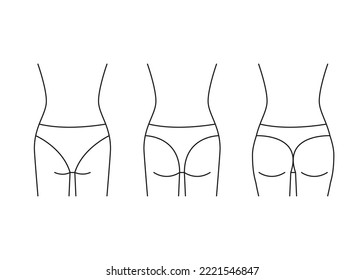 Types of butt woman, shape buttock back, line icon. Augmentation, reshape buttocks from small, flat in full booty. Cosmetic medical procedures, clinic of plastic surgery. Vector outline illustration