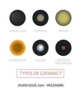 Types of cataract, vector. Human eye disorder