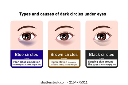 Types And Causes Of Dark Circles Under Eyes. Vector Illustration