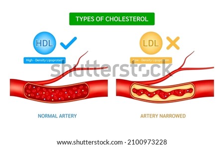 Types of cholesterol comparison with HDL High density lipoprotein and LDL Low Density Lipoprotein. Normal blood flow and Cholesterol artery thrombosis microvascular disease. ​​3D Vector illustration.