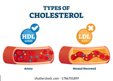 Types of cholesterol comparison with HDL and LDL lipoprotein vector illustration. Labeled educational normal and narrowed artery cross section explanation. Physiological high fat diet problem example.