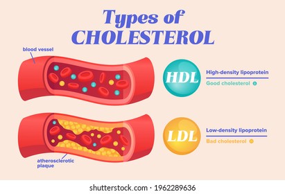 Types of cholesterol comparison with HDL and LDL lipoprotein. Labeled educational normal and narrowed artery cross section explanation. Physiological high fat diet problem example. Vector illustration