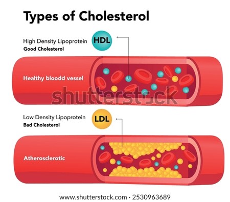 Types of cholesterol comparison with HDL and LDL stock illustration. Types of cholesterol. Normal and narrowed artery for explanation diseases. stock illustration