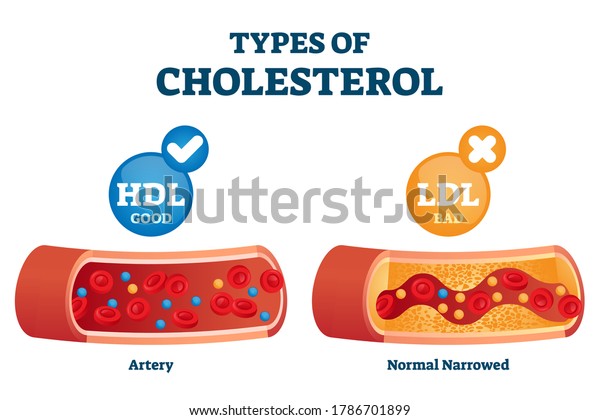 Types of cholesterol comparison with HDL and LDL\
lipoprotein vector illustration. Labeled educational normal and\
narrowed artery cross section explanation. Physiological high fat\
diet problem example.