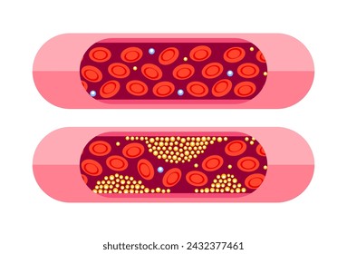 Types of cholesterol. HDL and LDL cholesterol types. Labeled educational normal and narrowed artery. Vector illustration