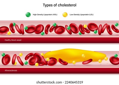 Tipos de colesterol. Lipoproteína de alta densidad (HDL) y Lipoproteína de baja densidad (LDL). Comparación de vasos sanguíneos sanos y aterosclerosis.