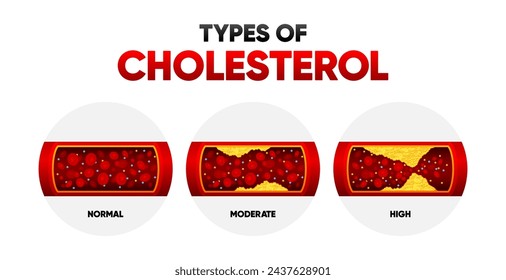 Tipos de colesterol. LDL y nivel HDl. Arterioesclerosis, infarto, isquemia, enfermedad de trombosis. Colesterol en los vasos sanguíneos humanos. Ilustración vectorial.