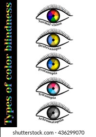 Types of color blindness. Violation of color perception: deuteranopia, protanopia, tritanopia, achromatopsia.   