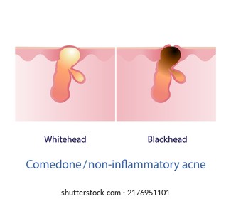 Types of comedone, non inflammatory acne vector on white background. Closed comedone, whitehead. Open comedone, blackhead. Skin care and beauty concept illustration.