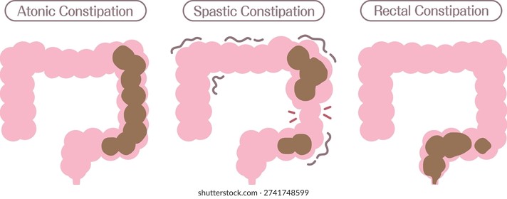 Types of Constipation Diagram Showing Atonic Spastic and Rectal Constipation