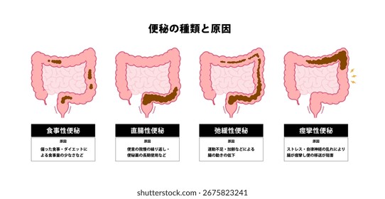 Tipos de Ilustración vectorial del estreñimiento.Traducción: Estreñimiento dietético, estreñimiento rectal, estreñimiento atónico, la cantidad reducida de alimentos debido a la dieta, etc.