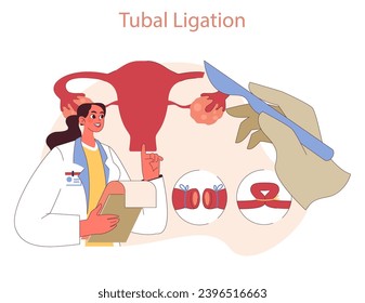 Types of Contraception. Doctor explains tubal ligation as a permanent contraceptive method. Empowering informed reproductive choices. Flat vector illustration
