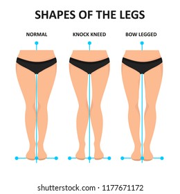 Types of curvatures human feet.