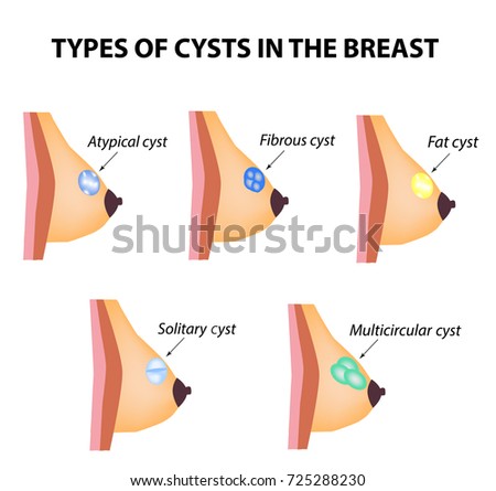 picture of breast cysts Evil big tits