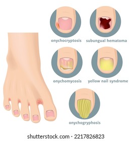 Types of damage to the toenails. Foot with fungus. Medical poster. Vector illustration