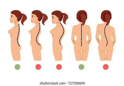 Types of deformation of the spine Scoliosis, lordosis, kyphosis. Correct and incorrect posture. Vector illustration