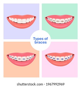 Types of Dental Braces. Smiling white teeth and pink lips. Ceramic braces. Colors braces. Smile With Braces.