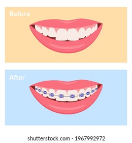 Types of Dental Braces. Smiling white teeth and pink lips. Ceramic braces. Colors braces. Smile With Braces.