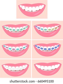 Types of Dental Braces. Smiling white teeth and pink lips. Ceramic braces. Colors braces. Smile With Braces. 