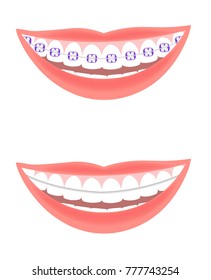 Types of Dental Braces. Smiling white teeth and pink lips. Ceramic braces. Colors braces. Smile With Braces.