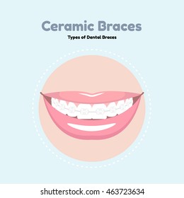 Types of Dental Braces. Vector flat illustration of smile with braces on the teeth. 