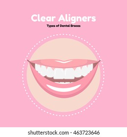 Types of Dental Braces. Vector flat illustration of smile with aligners on the teeth. 