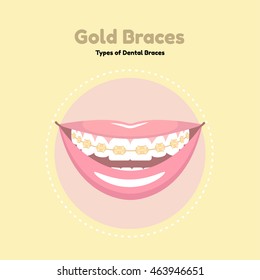 Types of Dental Braces. Vector flat illustration of smile with braces on the teeth. 