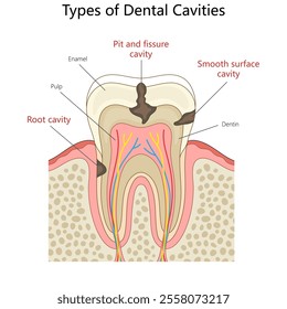 types of dental cavities. root cavity, pit and fissure cavity, and smooth surface cavity diagram hand drawn schematic vector illustration. Medical science educational illustration