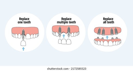 Types of dental implants to replace one tooth, multiple teeth and all teeth