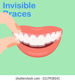 Types of Dental. Smiling white teeth and pink lips. Ceramic, Colors braces. Smile With Braces. wearing orthodontic silicone trainer. Invisible braces aligner. invisalign. removable braces.