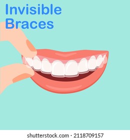 Types of Dental. Smiling white teeth and pink lips. Ceramic, Colors braces. Smile With Braces. wearing orthodontic silicone trainer. Invisible braces aligner. invisalign. removable braces.