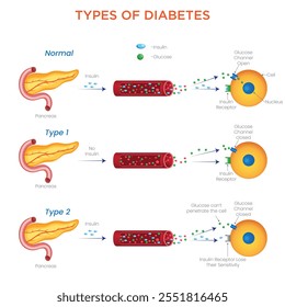 Un diagrama de "Tipos de diabetes" distingue visualmente la diabetes tipo 1, tipo 2 y gestacional, destacando las causas, los síntomas y las estrategias de manejo.