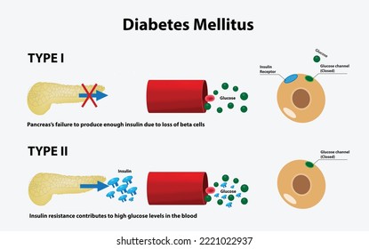 Tipos de Diabetes Mellitus vectorial Ilustración, Tipo I y Tipo II