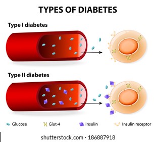 Types of Diabetes. Type 1 and Type 2 Diabetes Mellitus. Insulin-Dependent Diabetes Mellitus and Non Insulin-Dependent Diabetes Mellitus. Insulin resistance and insufficient insulin production.