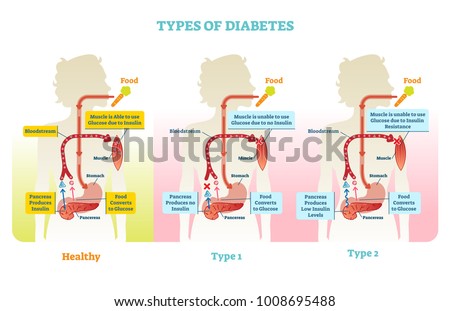 Types of diabetes vector illustration diagram scheme. Medical educational information.