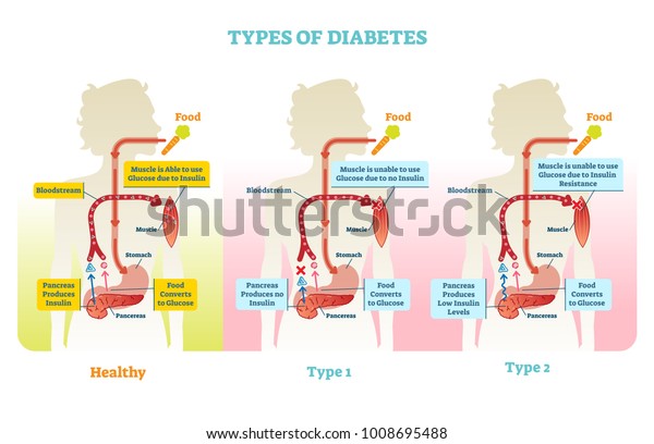 Types Diabetes Vector Illustration Diagram Scheme Stock Vector Royalty Free