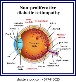 Types of diabetic retinopathy: non-proliferative diabetic retinopathy .