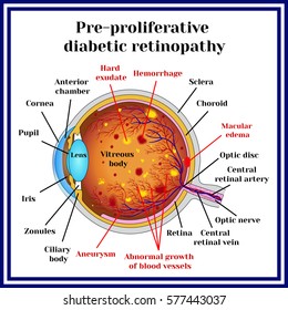 Types of diabetic retinopathy: pre-proliferative diabetic retinopathy .