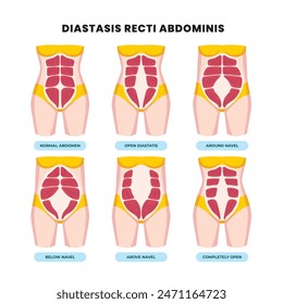 Types of diastasis recti poster scheme, medical education banner, abdominal separation, pregnant women. Abdomen muscles, anatomy, postpartum care, six pack separation belly rectus Linea alba abdominal