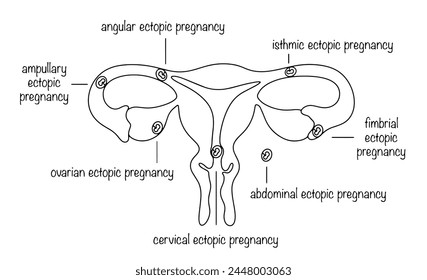 Types of ectopic pregnancy. Pregnancy when the egg is not implanted in the uterus. Line medical illustration with captions.