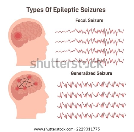 Types of epilepsy. Generalized and focal seizures. Human brain electrical connectivity and activity. EEG infographic. Flat vector illustration