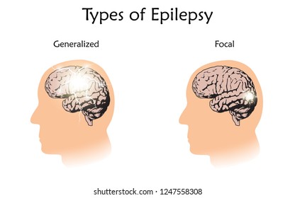 Types of epilepsy. Vector medical illustration. Generalized, focal seizures. White background, silhouette of man head, anatomy flat image of brain, electrical discharge.