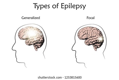 Types of epilepsy. Vector medical illustration. Generalized, focal seizures. White background, line silhouette of man head, anatomy flat image of brain, electrical discharge.