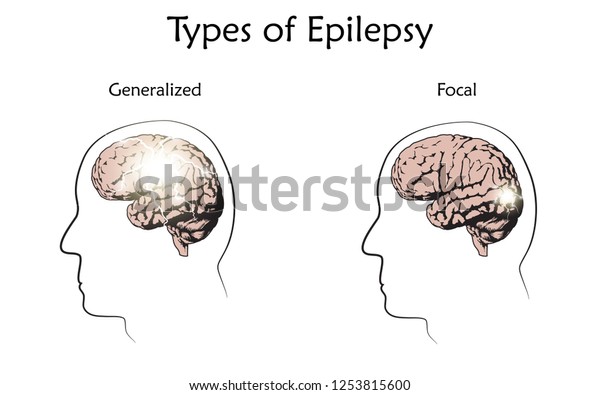 Types Epilepsy Vector Medical Illustration Generalized Stock Vector ...