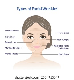 Types of facial wrinkles vector illustration isolated on white background. Forehead, Bunny, Marionette, Frown lines, Mental crease, Crows feet, Tear troughs, Nasolabial folds, Smile and Neck lines.