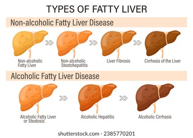 Types of fatty liver. Human liver diseases. Alcoholic and non-alcoholic fatty liver. Hepatitis, liver cirrhosis, fibrosis, steatosis. Medical infographic banner. Vector