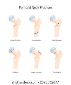 Types of Femoral Neck Fracture Disease