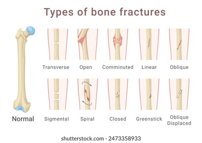 Types of femoral shaft bone fracture medical scheme infographic isometric vector illustration. Human anatomical injury skeleton body femur hip trauma skeletal disease accident info diagram description