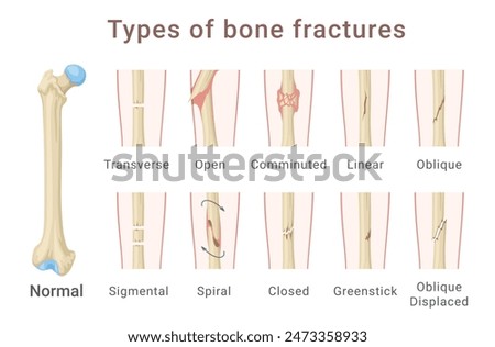 Types of femoral shaft bone fracture medical scheme infographic isometric vector illustration. Human anatomical injury skeleton body femur hip trauma skeletal disease accident info diagram description